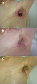 Approved by the cancer.net editorial board, 07/2019. The Utility Of Hyperthermia For Local Recurrence Of Breast Cancer World Journal Of Surgical Oncology Full Text