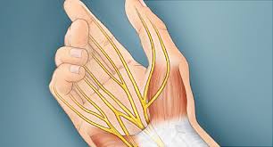 A Visual Guide To Carpal Tunnel Syndrome