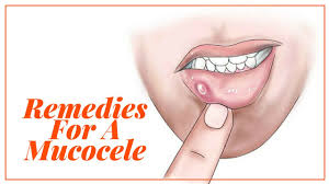 A ranula presents as a painless, cystic, bluish swelling in the floor of the mouth. Home Remedies For A Mucocele Youtube