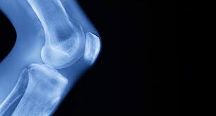 It's the most common the main symptoms of osteoarthritis are joint pain and stiffness, and problems moving the joint. Visual Guide To Understanding Osteoarthritis