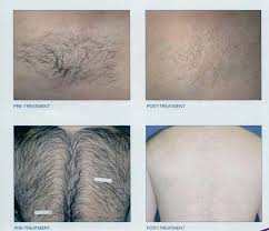 Vaginal hair removal with laser. Laser Hair Removal Permanently Remove Unwanted Hair