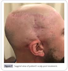 Of course, your specialist is the main person whose advice you should follow but it doesn't do anyone harm. Modern Treatment Of Head And Neck Melanoma Case Report And Review Of Literature Insight Medical Publishing