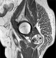 Image result for Liposarcoma