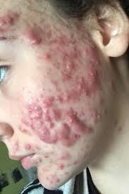 When under the care of your dermatologist or doctor, isotretinoin or accutane is mostly considered safe and one of the most effective treatments for severe acne. Accutane Before And After 9 Women On Their Isotretinoin Side Effects