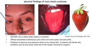 Usually the infections caused by these bacteria are mild. Toxic Shock Syndrome Tss Emcrit Project