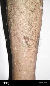 Image result for liver spots on legs