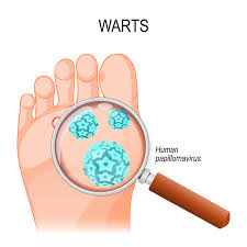 Take a look at these pictures of warts to see the various types. What Causes Foot Warts Cincinnati Foot Ankle Care