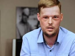 California man makes extraordinary recovery after breaking EVERY bone in  his face