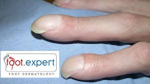 Image result for Clubbing nails feet