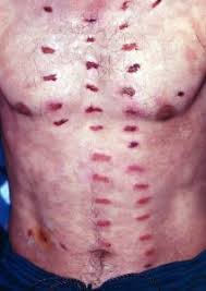 Image result for Neurotic Excoriation