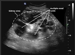 Emdocs Net Emergency Medicine Educationnephrolithiasis Diagnosis And Management In The Ed Emdocs Net Emergency Medicine Education