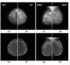 Image result for Mammogram Interpretation