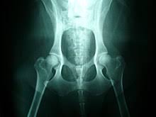 That's why it's so important to be able to recognize the signs and seek. Hip Dysplasia Canine Wikipedia