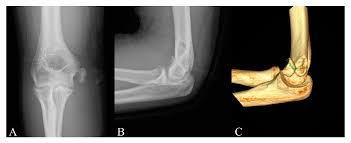 A medial epicondyle fracture is an avulsion injury of the attachment of the common flexors of the forearm. Diagnostics Free Full Text Is Computed Tomography Necessary For Diagnostic Workup In Displaced Pediatric Medial Epicondyle Fractures Html