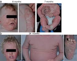 And pilaris suggests the involvement of hair follicles in this disorder. Target Sequence Capture And High Throughput Sequencing Identify A De Novo Card14 Mutation In An Infant With Erythrodermic Pityriasis Rubra Pilaris Html Acta Dermato Venereologica