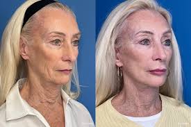 Facelift & Neck Lift Before & After Gallery: Patient 4