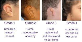 Microtia Ear Surgery And Bone Anchored Hearing Devices Sheryl Lewin Surgery Ear Middle Ear