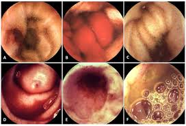 Image result for Small Intestinal Bleeding