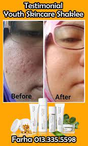 Salah satu yang paling terkenal di indonesia tentang produk pemutih wajah adalah brand dari royalty kosmetik. Produk Paling Berkesan Untuk Memutihkan Kulit
