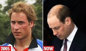 Prince william's hair trouble is becoming quite apparent and he may soon be going bald. What A Bad Heir Day Prince William Faces Some Ribbing About Hair Loss Hair Loss About Hair Face
