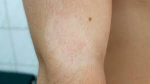 We did not find results for: Neurodermitis In Bildern So Sieht Neurodermitis Aus