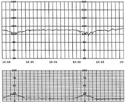 Image result for Early Deceleration