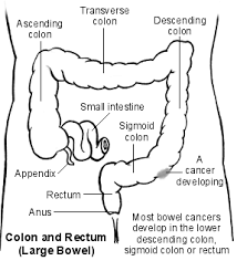 Causes of bowel cancer we believe that all malignancies of the bowel probably start off as benign polyps. Http Www Wales Nhs Uk Sites3 Documents 242 Colorectal1 Pdf