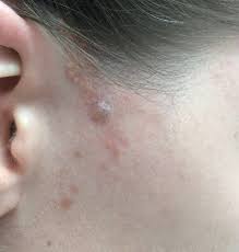 The characteristic skin lesion that affects individuals with nevus sebaceus syndrome is a sebaceous nevus, which is a type of epidermal nevus. Basal Cell Carcinoma Arising In Nevus Sebaceous During Pregnancy Mdedge Dermatology