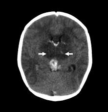 Cerebral venous sinus thrombosis occurs when a blood clot forms in the brain's venous sinuses. Diagnosis And Management Of Cerebral Venous Thrombosis Stroke