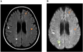 We did not find results for: Concurrent Guillain Barre Syndrome Transverse Myelitis And Encephalitis Post Zika A Case Report And Review Of The Pathogenic Role Of Multiple Arboviral Immunity Sciencedirect