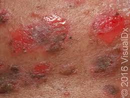 Image result for Pemphigus