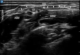 Image result for Superior Trunk Block