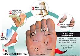 Tinea Pedis Athlete S Foot Best Ways To Treat It