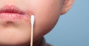 The best treatment for oral herpes is antiviral oral medication. Cold Sores Herpes Simplex