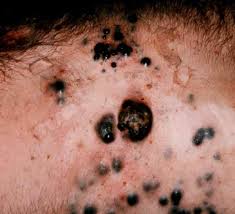 Das maligne melanom ist ein aggressiver, von den melanozyten ausgehender tumor der haut. Malignes Melanom Deximed