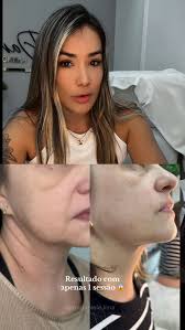 Tratamento MUITO MAIS ACESSÍVEL💲😍, Método regenerador do tecido com  flacidez que entrega resultados visíveis já na PRIMEIRA SESSÃO !!!!, Venha  fazer uma avaliação comigo !!! , 21 96496-1315 link na ...