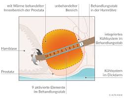 Wichtige informationen und fakten zur männlichen vorsteherdrüse verständlich aufbereitet. Prostatavergrosserung Symptome Behandlung Therapie Alta Klinik