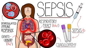 Image result for Sepsis