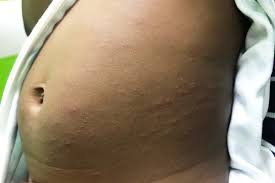 Image result for sweat rash on back