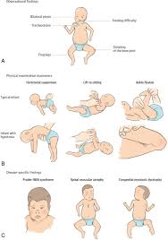 Image result for Floppy Infant