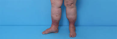 Image result for Lipodermatosclerosis