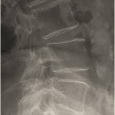 Check out our vertebrae pictures selection for the very best in unique or custom, handmade did you scroll all this way to get facts about vertebrae pictures? Picture Frame Appearance Of Vertebral Bodies On Lateral Lumbar Spine Download Scientific Diagram