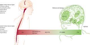 It's often called lou gehrig's disease, after a famous baseball player who died from the disease. Amyotrophic Lateral Sclerosis The Lancet