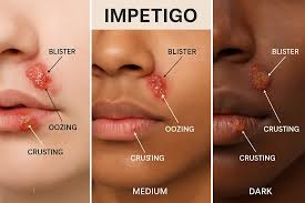 Image result for Impetigo