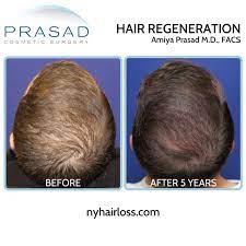 Typically at least the head is involved. Why Acell Prp Treatments Are Not All The Same Hair Regeneration