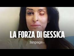 Contact gessica notaro on messenger. Sfregiata Con L Acido Gessica Notaro Si Mostra Senza Benda Oggi E Un Giorno Particolare Youtube