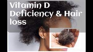This causes premature hair loss and thinning. Answering Your Questions Live Vitamin D Deficiency Hair Loss And Illnesses Youtube