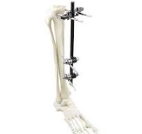 China China New Product Surgical Distal Medial Tibia Locking ...