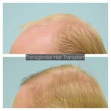 Pin On Transgender Hair Transplant