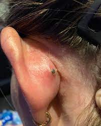 Pus Or Lymph Piercing